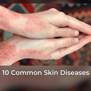 10 Common Skin Diseases: