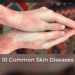 10 Common Skin Diseases: