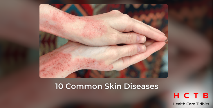 10 Common Skin Diseases: