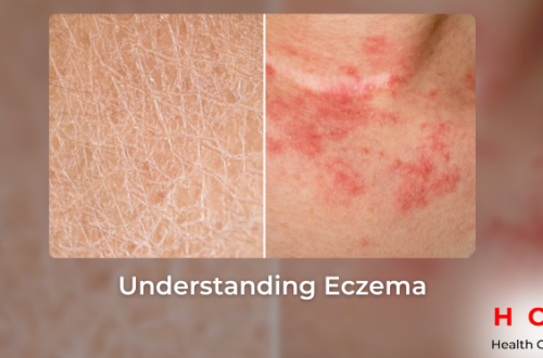 Understanding Eczema