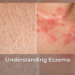 Understanding Eczema