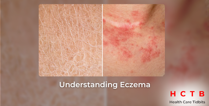 Understanding Eczema