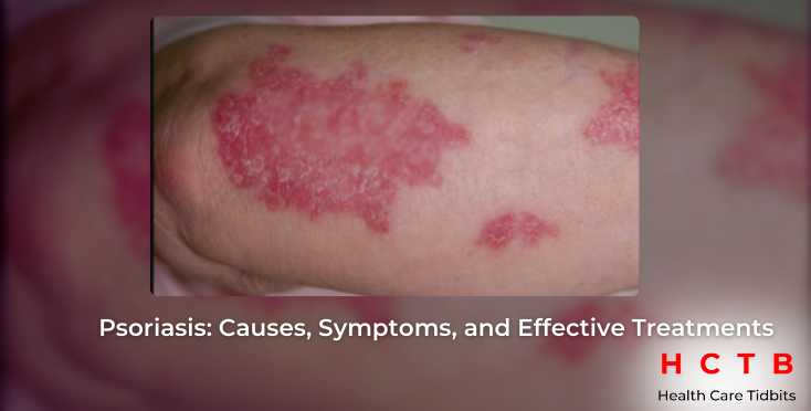 Psoriasis