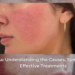 Rosacea