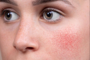 Rosacea