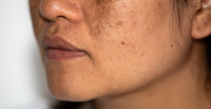 Melasma