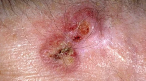 Skin Cancer