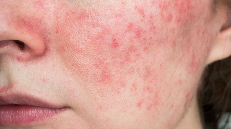 Rosacea