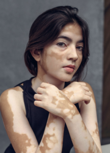 Vitiligo