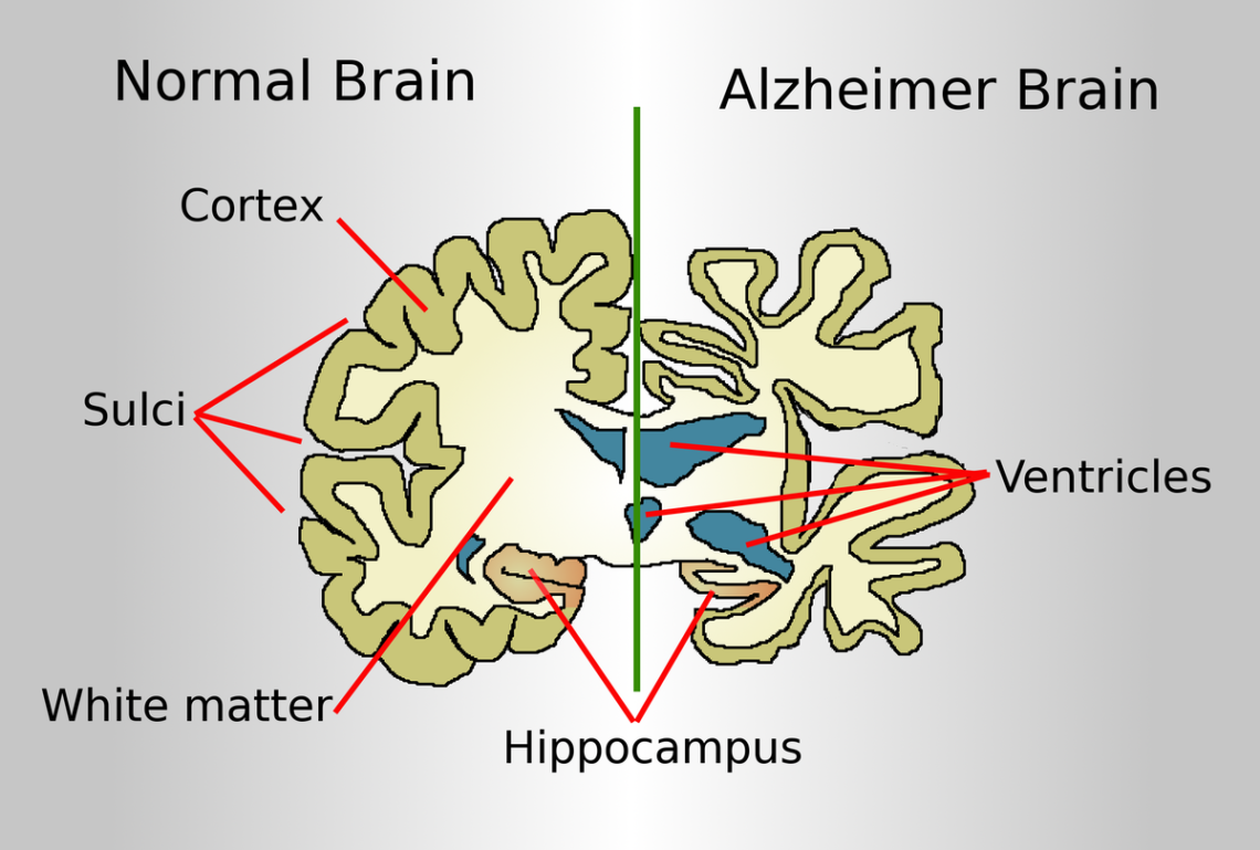 Alzheimer's Disease and Dementia