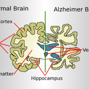 Alzheimer's Disease and Dementia