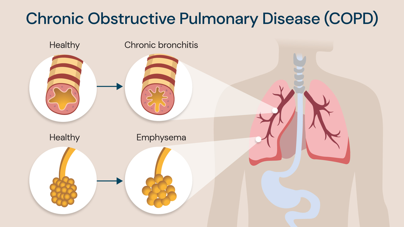 Chronic Obstructive Pulmonary Disease (COPD)