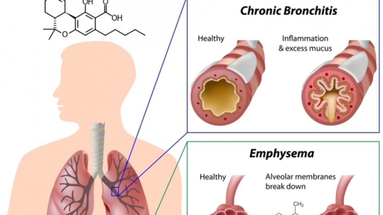 Chronic Obstructive Pulmonary Disease (COPD)