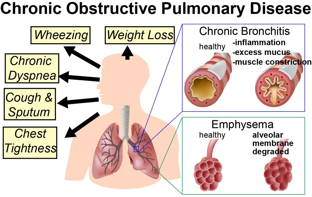 Chronic Obstructive Pulmonary Disease (COPD)