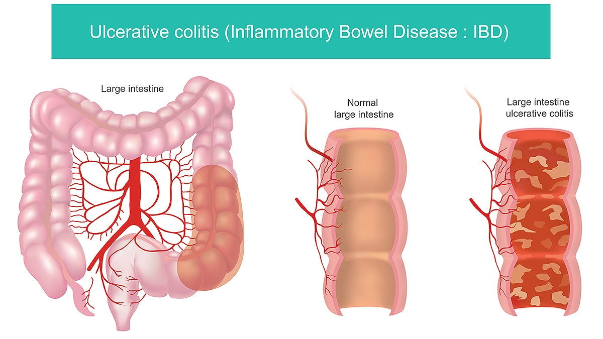 Inflammatory Bowel Disease (IBD)