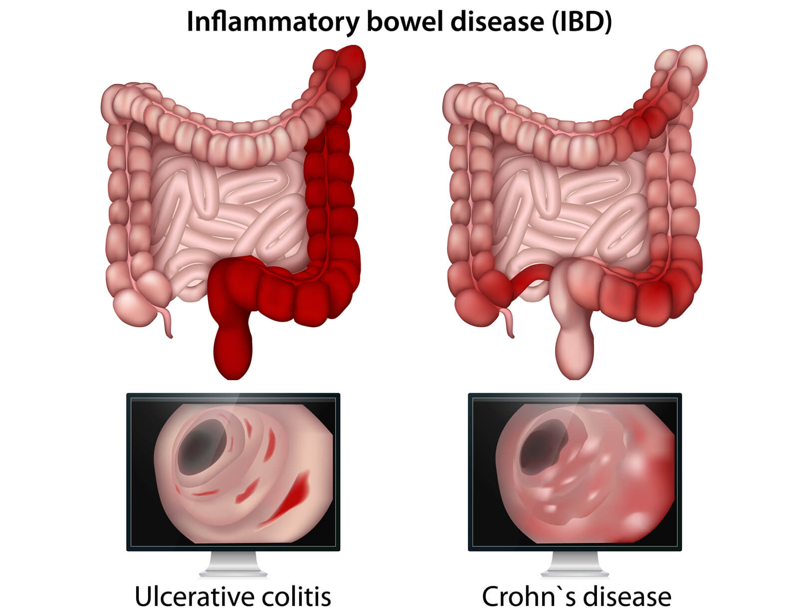 Inflammatory Bowel Disease (IBD)