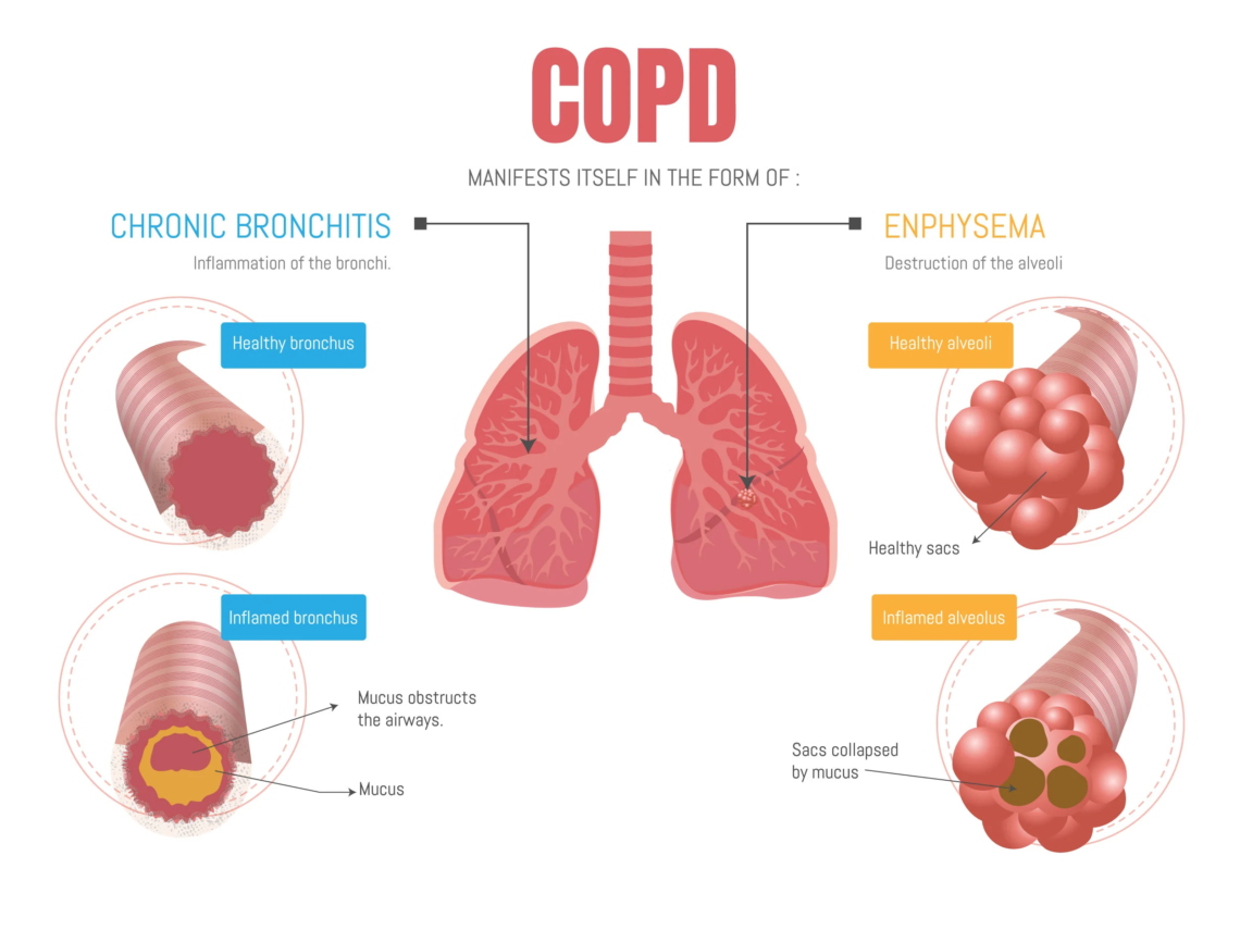 Chronic Obstructive Pulmonary Disease (COPD)