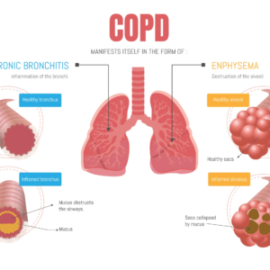 Chronic Obstructive Pulmonary Disease (COPD)