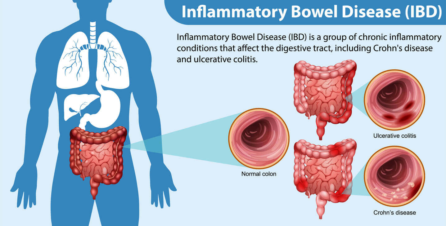 Inflammatory Bowel Disease (IBD)