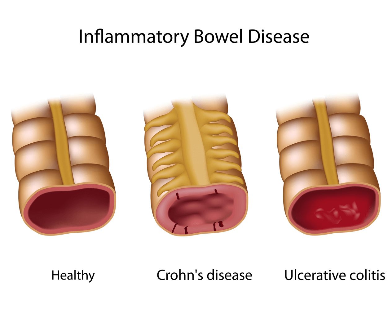 Inflammatory Bowel Disease (IBD)