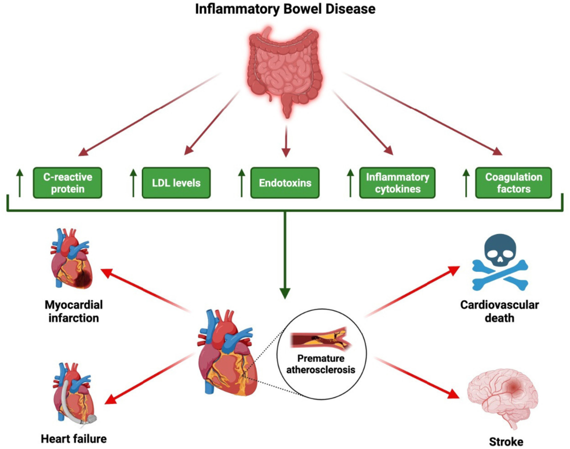 Inflammatory Bowel Disease (IBD)