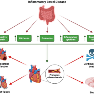 Inflammatory Bowel Disease (IBD)