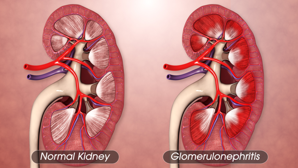 Kidney Infections