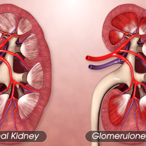 Kidney Infections