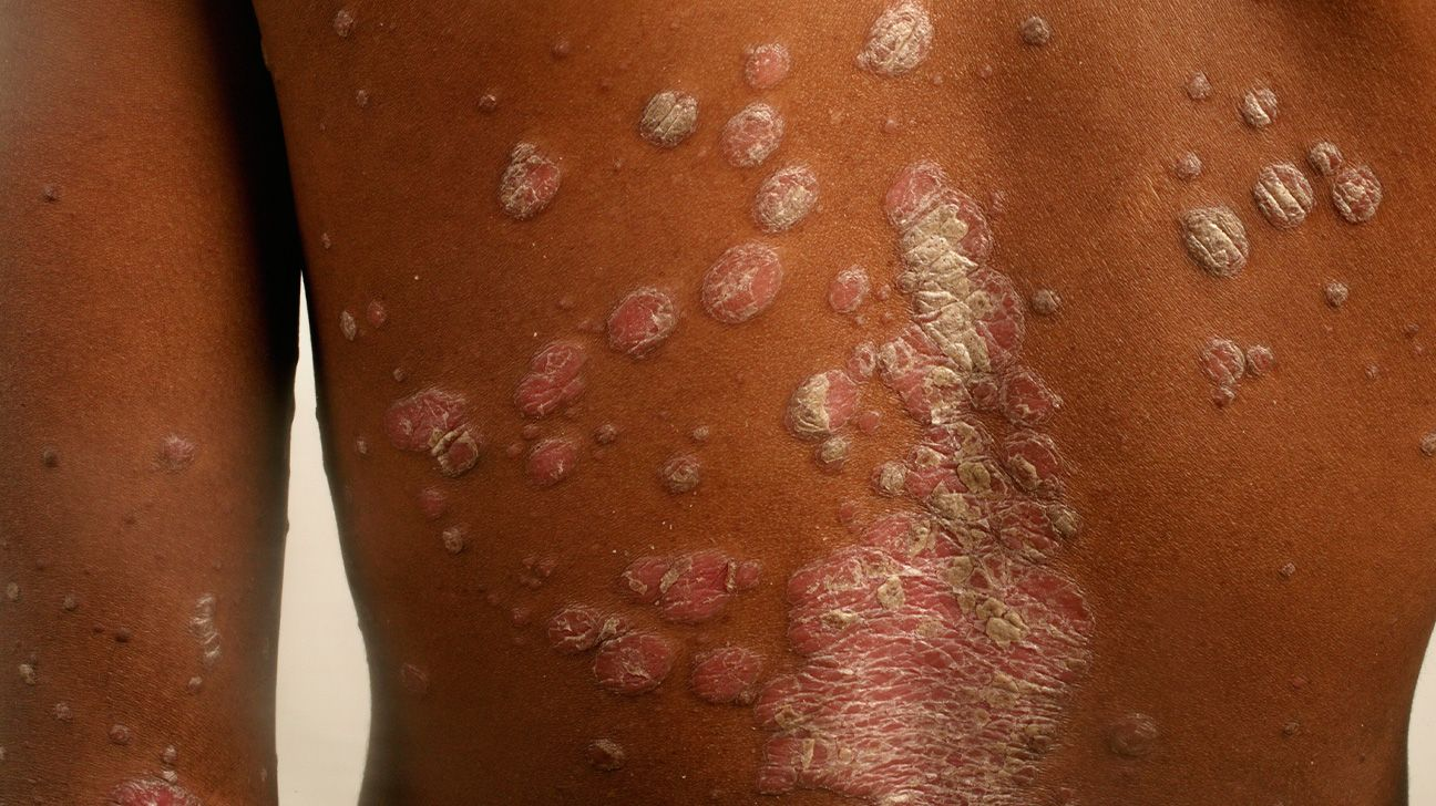 Psoriasis