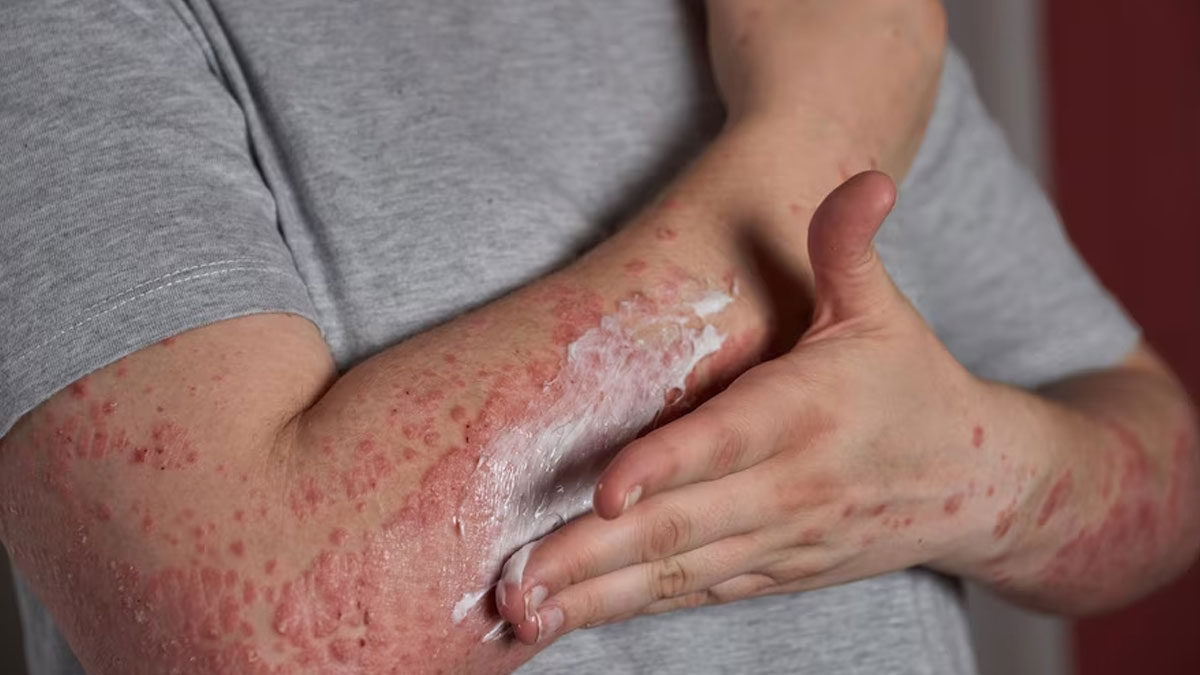 Psoriasis