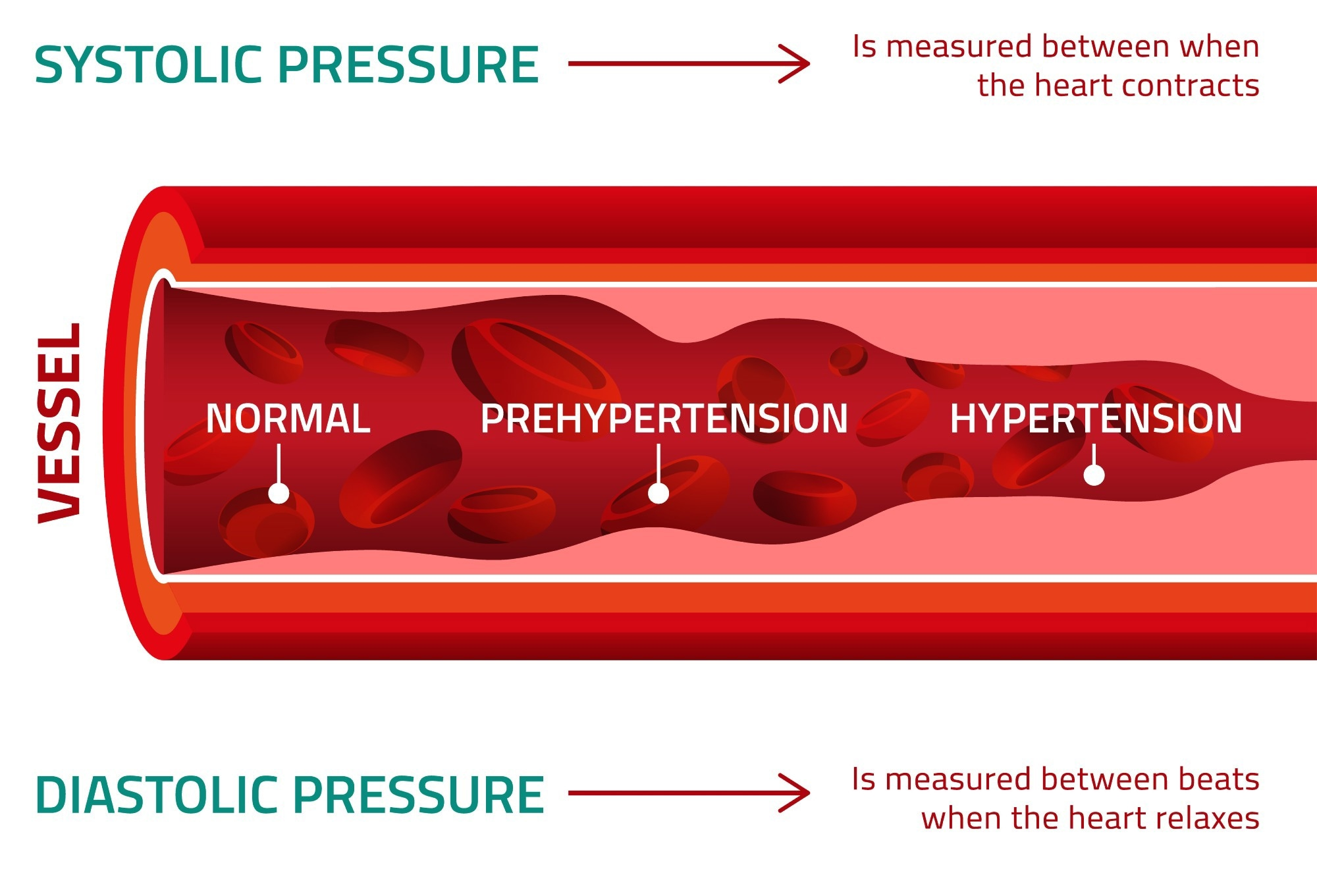 Hypertension