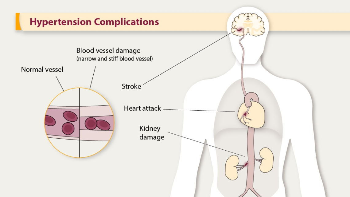 Hypertension