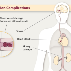 Hypertension