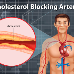 High Cholesterol