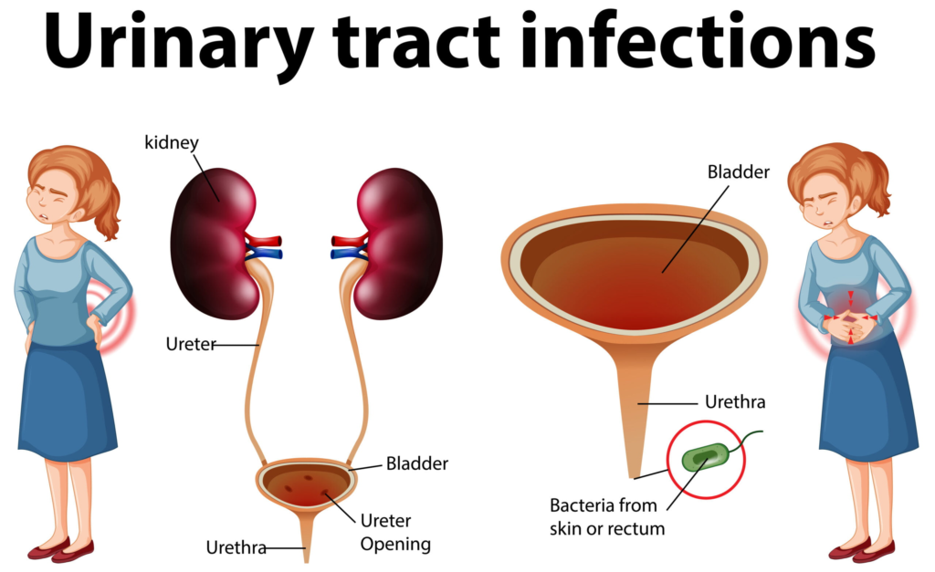 Kidney Infections